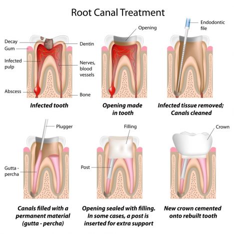 rootcanal